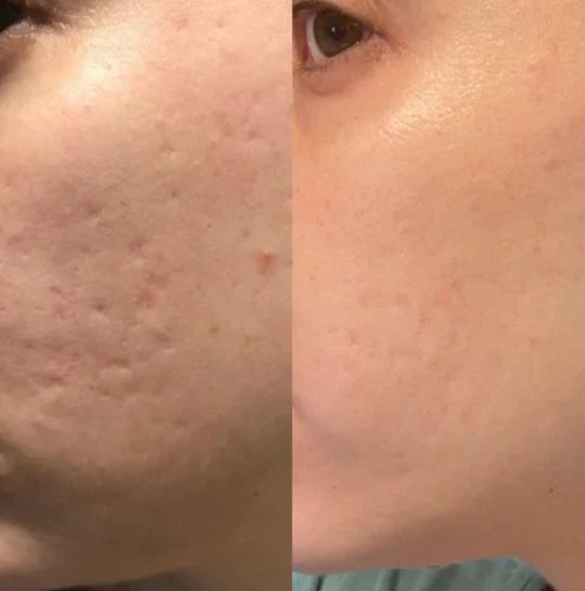 Lejuv Silicone Scar & Line Stick