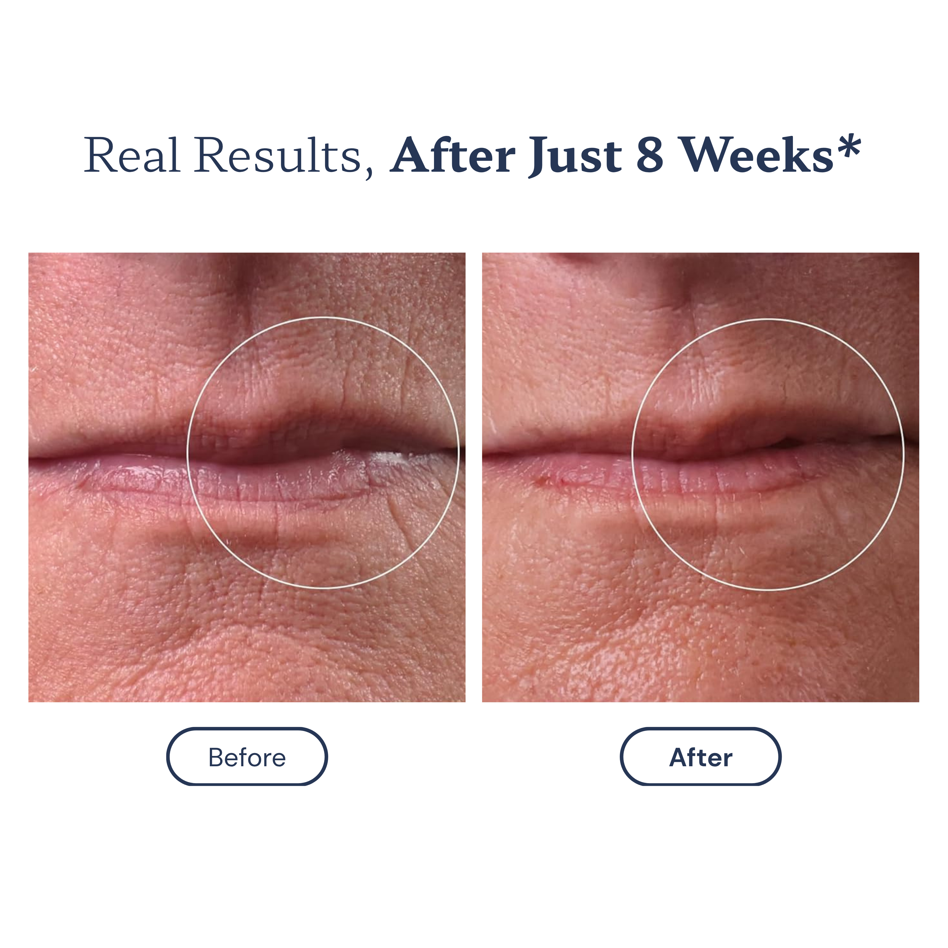 Lejuv™ Lip Line Therapy