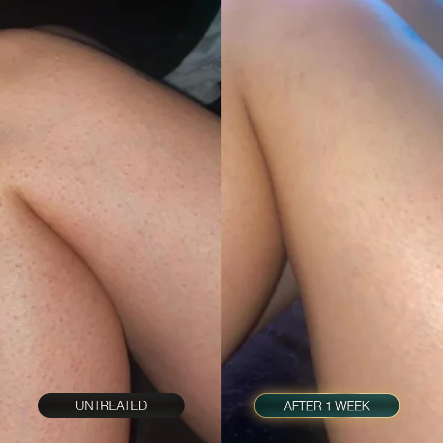 Lejuv for Body Bumps