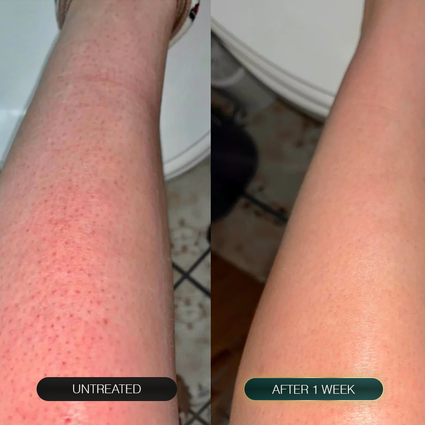 Lejuv for Body Bumps