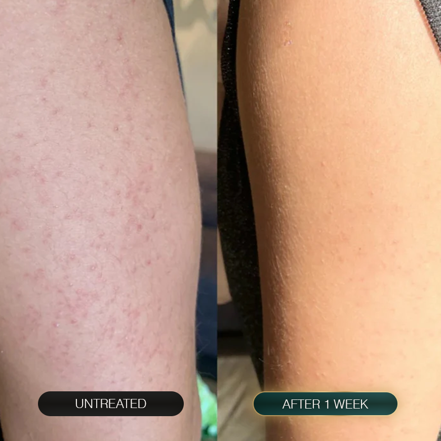 Lejuv for Body Bumps