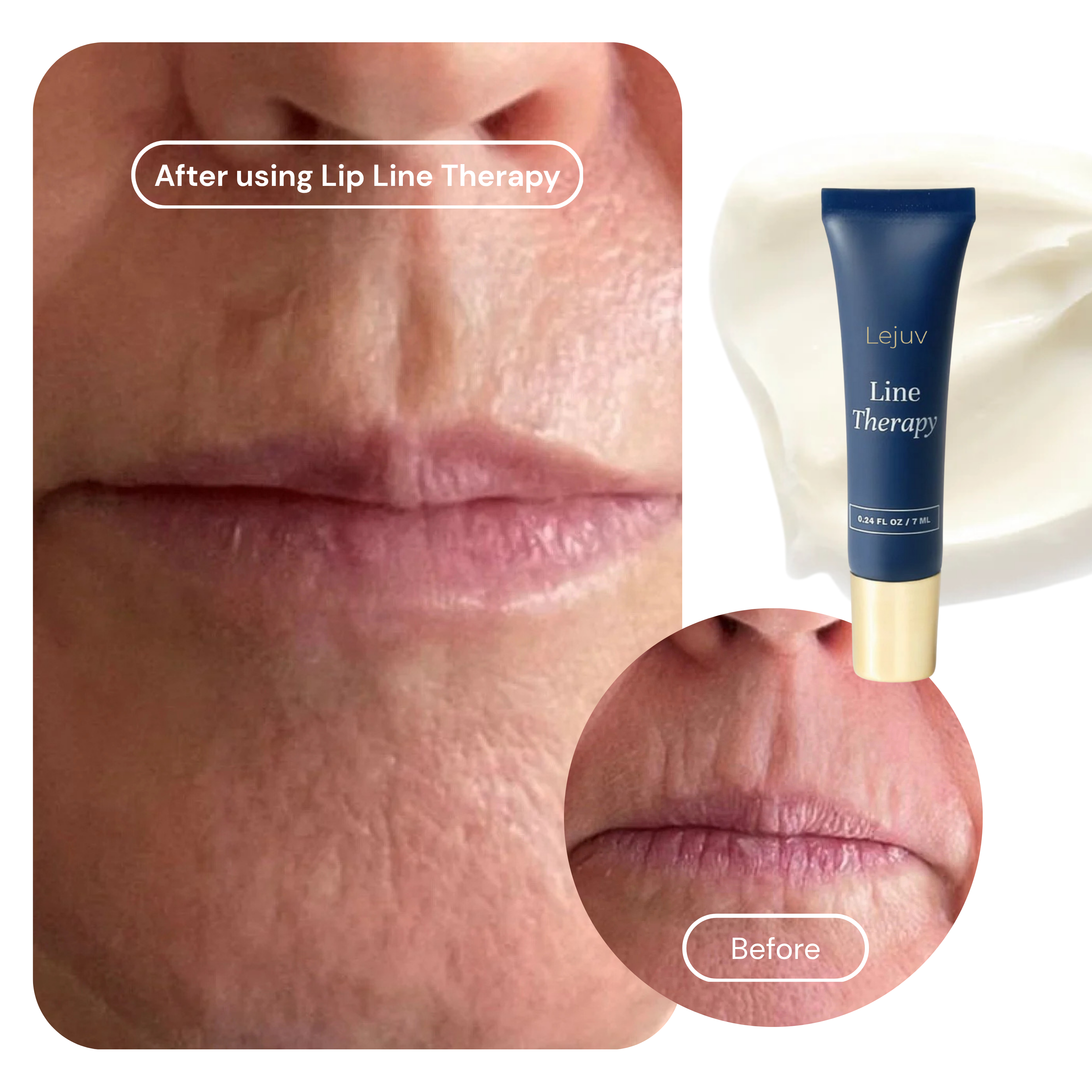 Lejuv™ Lip Line Therapy